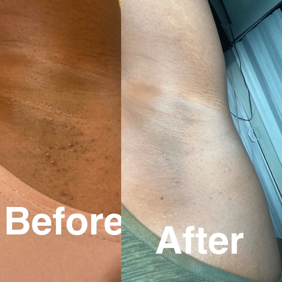 INVISI SKIN (Ingrown Hair/ Razor Bump solution)