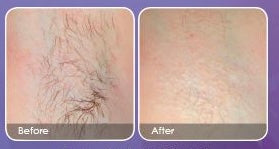 Hair Removal Mask